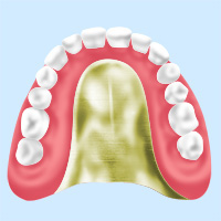 ゴールド床義歯