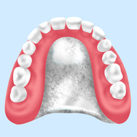 チタン床義歯