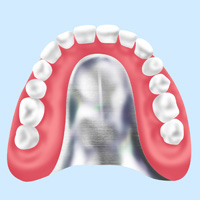 コバルトクロム床義歯