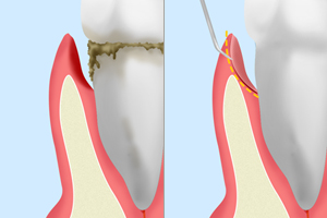 歯周ポケット掻爬（そうは）術