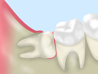 親知らずの抜歯
