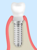 インプラント治療