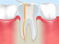 根管治療